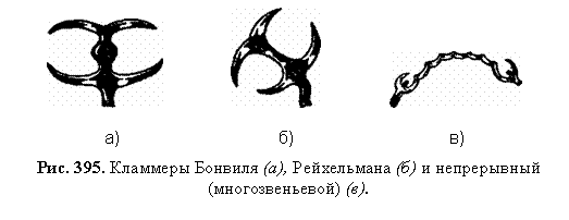 Подпись:                                    а)                                 б)                                в)  Рис. 395. Кламмеры Бонвиля (а), Рейхельмана (б) и непрерывный (многозвеньевой) (в).    